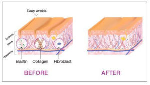 wrinkle reduction before-after