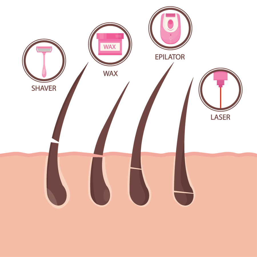 5 Questions to Ask Before Getting Laser Hair Removal ...