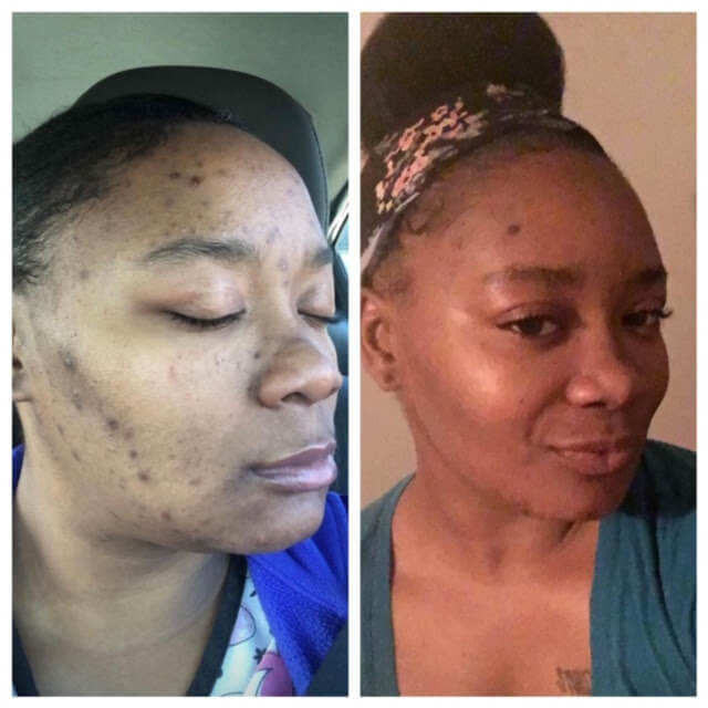 microderm and chemical peel results