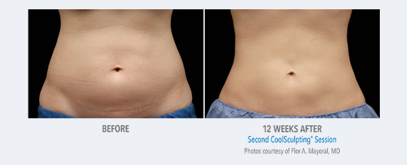belly CoolSculpting results