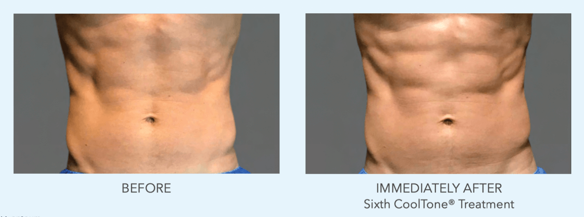 cooltone by coolsculpting results