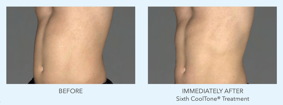 cooltone by coolsculpting results